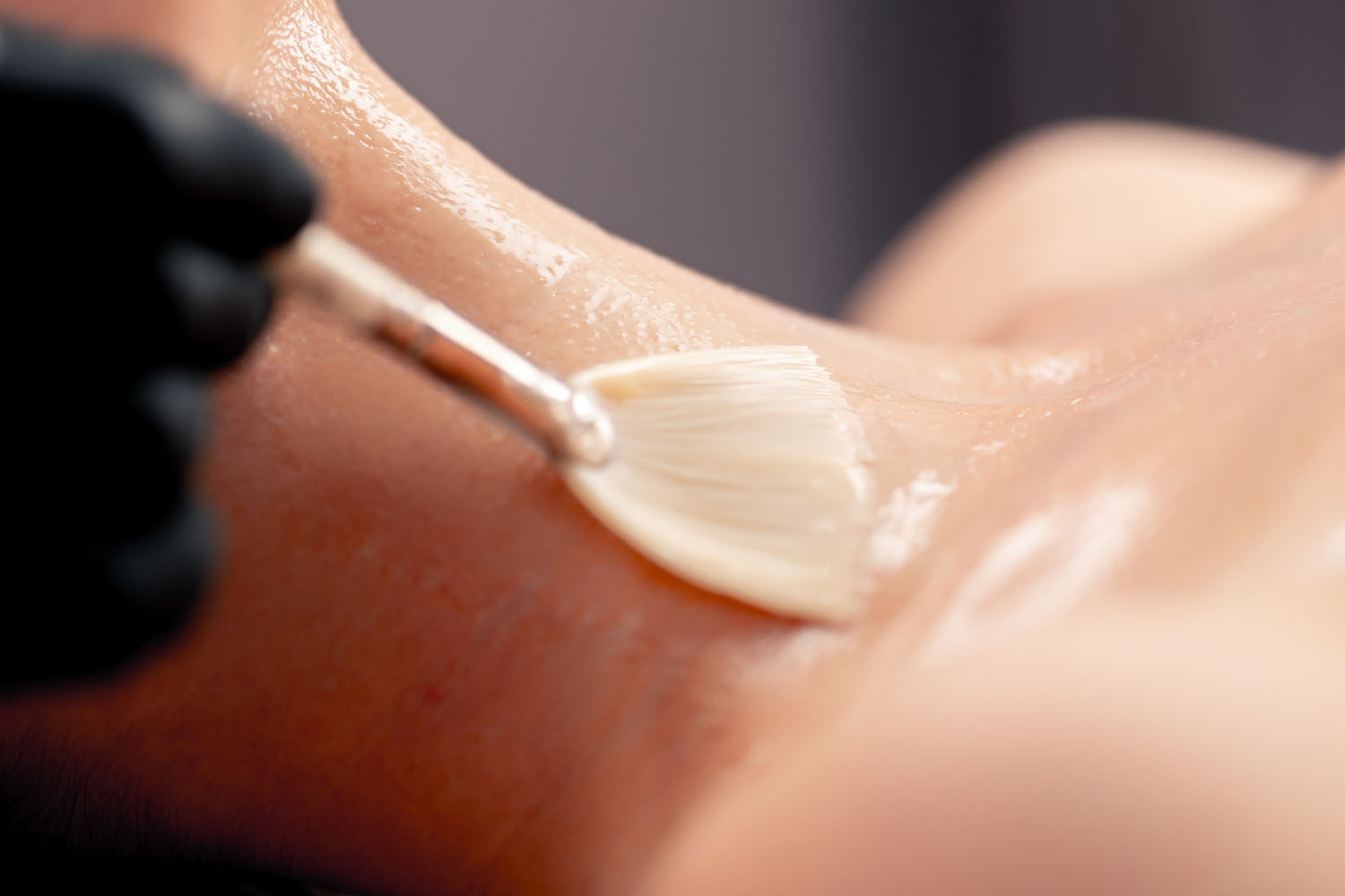 Chemical peel treatment at ADI MedSpa El Paso